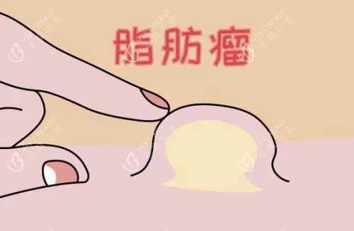 脂肪瘤漫画图