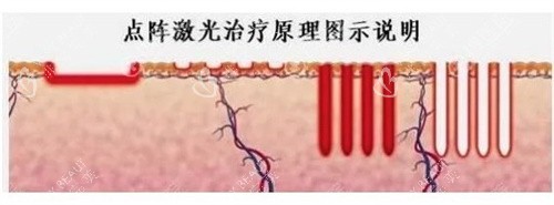 点阵激光祛疤