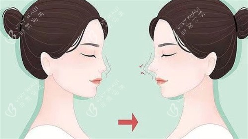 鼻修复对比 鼻修复对比