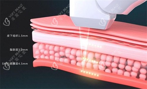 超声炮治疗深度