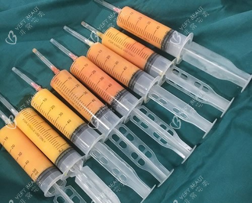 吸脂手术抽出来的脂肪照片