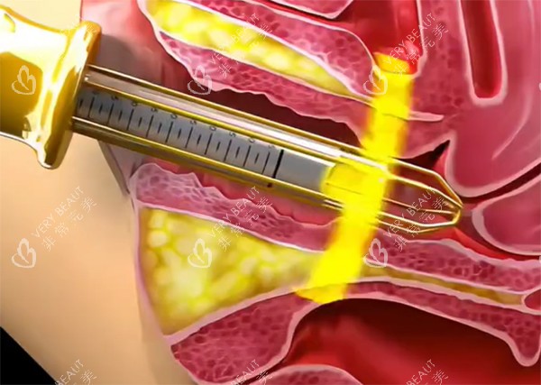 紧缩针紧缩推药照片