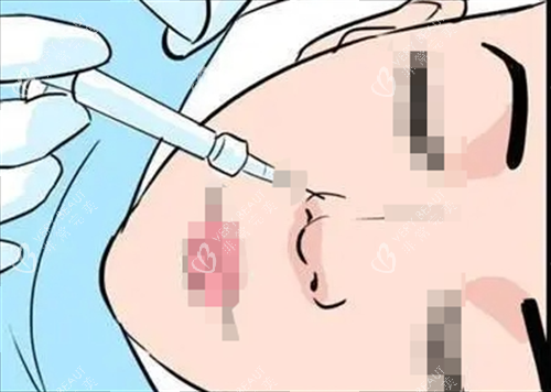 玻尿酸注射鼻子动画展示