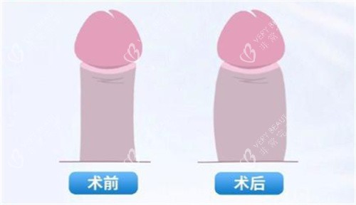 男性私密脂肪填充