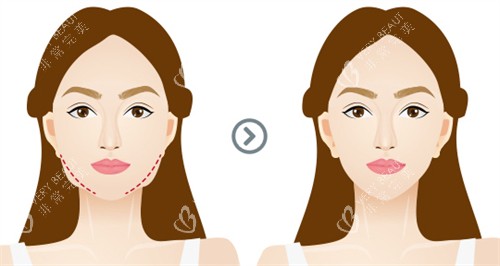 面部提升前后对比
