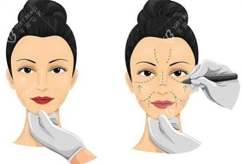 小拉皮手术过程