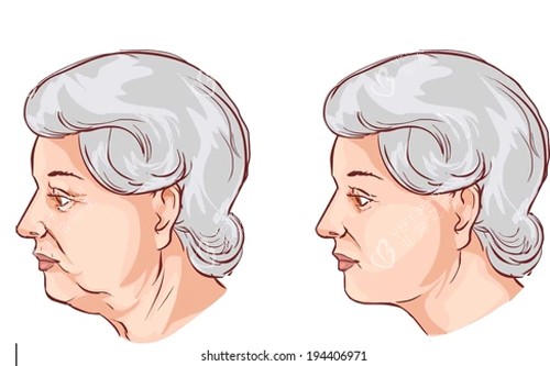 颈部拉皮卡通图 颈部拉皮卡通图