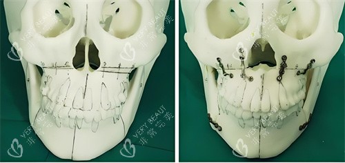 正颌手术手术原理展示图 正颌手术手术原理展示图