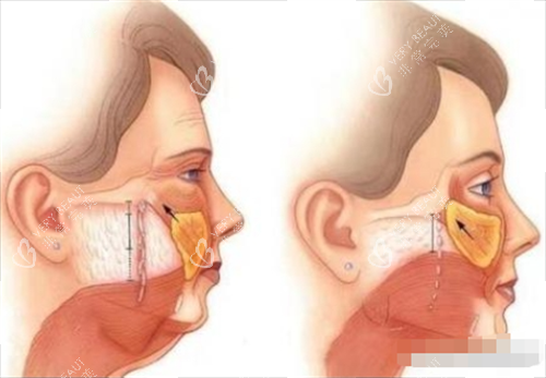 拉皮前后皮肤内部以及表面变化图