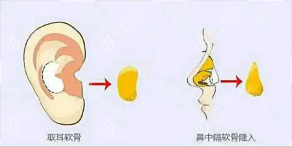 耳软骨隆鼻