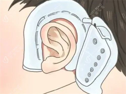 耳朵矫正器的形状