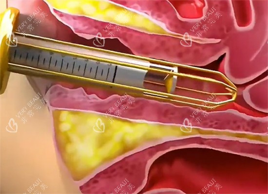 紧缩针过程示意图