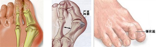 大脚骨的表现
