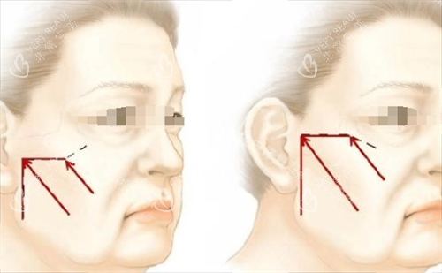 微拉美面部提升方向