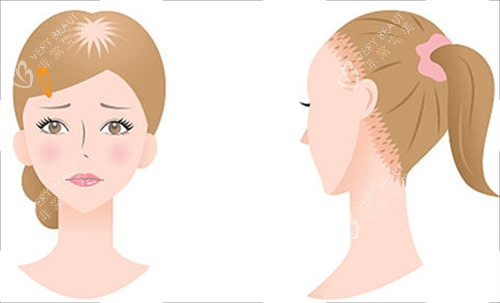 女生脱发类型 女生脱发类型