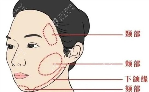 面部提升可以提升的区域