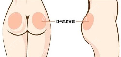 自体脂肪丰臀