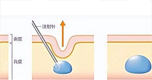 玻尿酸注射皮肤前后对比