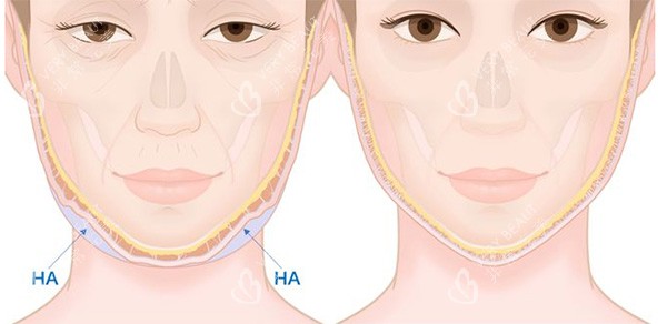 馒化脸改善前后变化