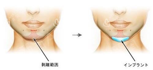 注射垫下巴示意图 注射垫下巴示意图