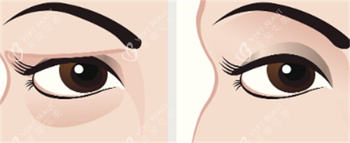 祛眼袋前后对比2 祛眼袋前后对比2