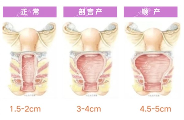 正常阴道和松弛对比照片 正常阴道和松弛对比照片