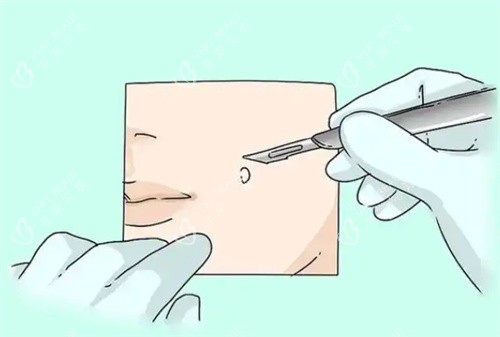 手术切痣卡通 手术切痣卡通