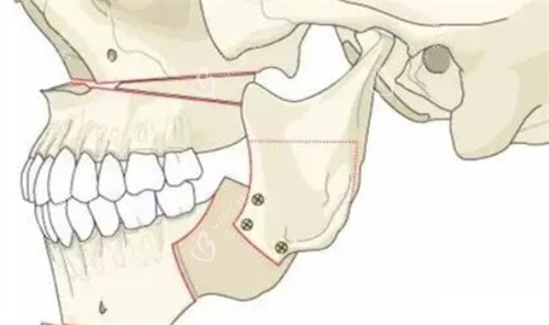正颌手术后的形状 正颌手术后的形状