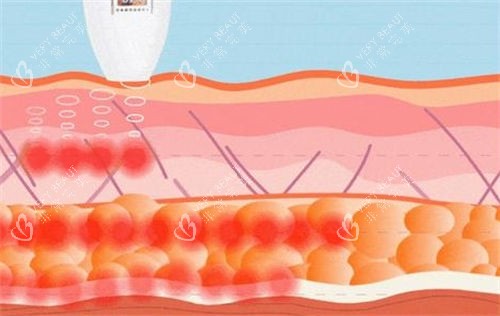 超声炮仪器作用在皮肤侧剖图