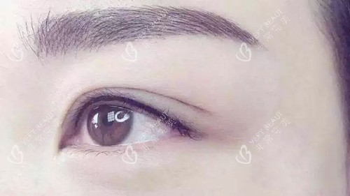 双眼皮实拍 双眼皮实拍