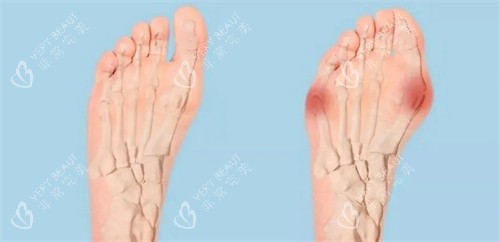正常脚和大脚骨