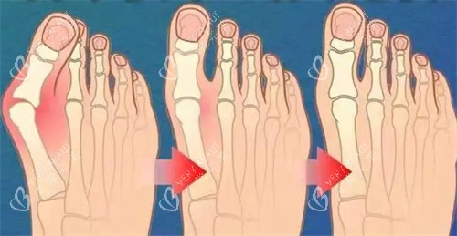 不同程度的大脚骨