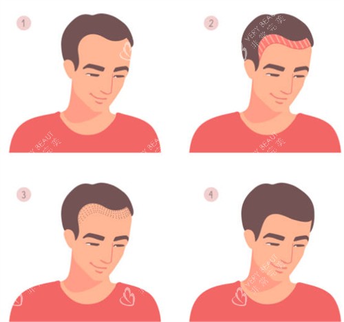 发际线植发前后图解 发际线植发前后图解