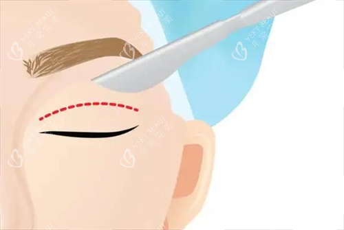 割双眼皮示意图
