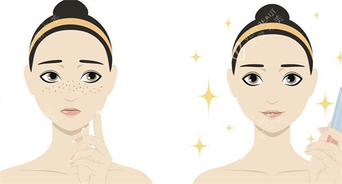 祛痣前后对比 祛痣前后对比