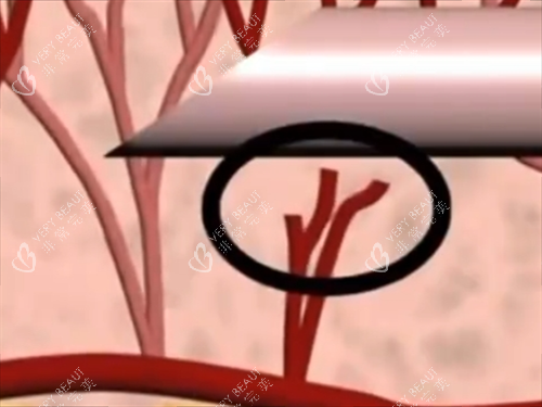 玻尿酸注射内部血管细节展示