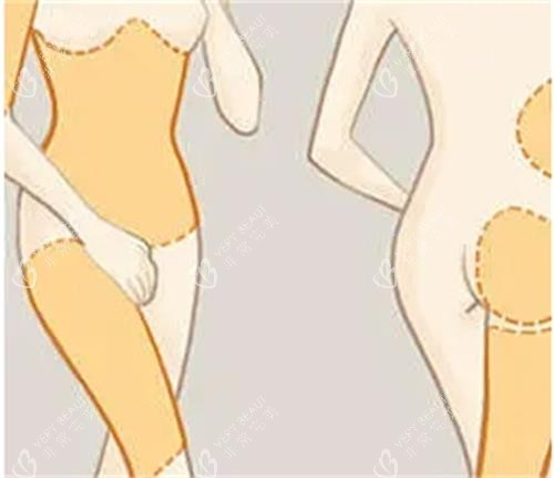 吸脂手术前后对比图