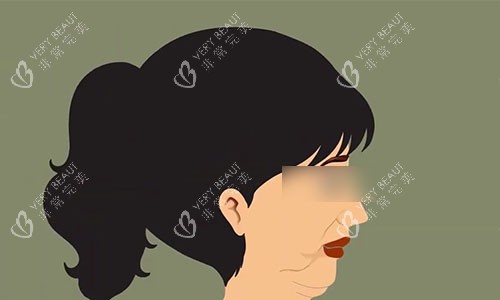 拉皮手术前的动画示意图