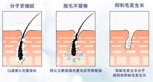 脱毛后毛囊的变化