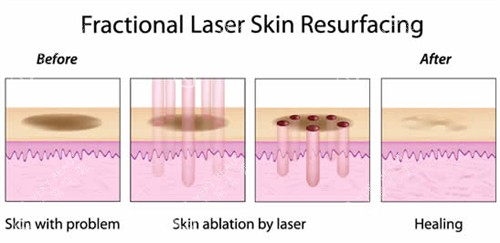 激光祛斑流程图 激光祛斑流程图