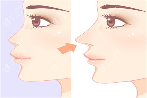 隆鼻手术前后展示图