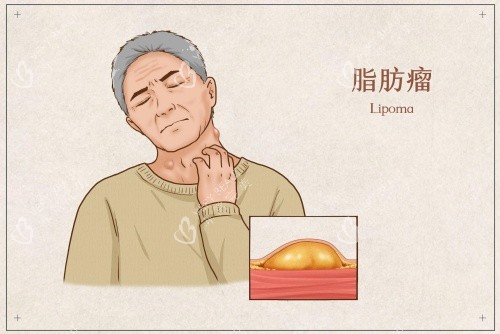 脂肪瘤生长部位示意图