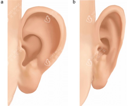 手术改善耳朵形状前后对比