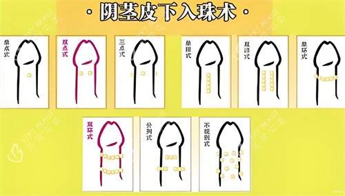 阴茎皮下入珠术