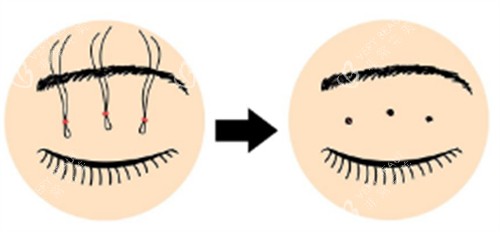 皮下速接双眼皮操作过程图解 皮下速接双眼皮操作过程图解