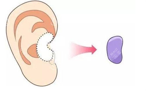 耳软骨隆鼻移除位置展示图