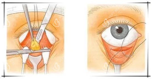 内切法祛眼袋卡通示意图