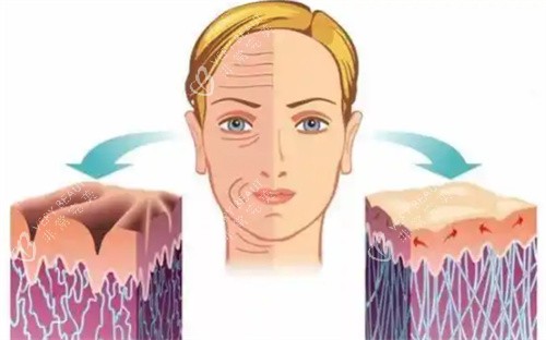 微拉美提升手术前后