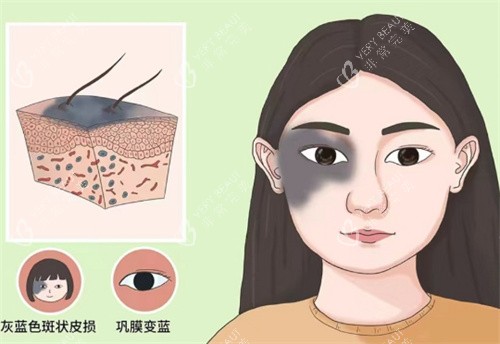 太田痣的样子 太田痣的样子