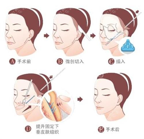 拉皮手术过程图